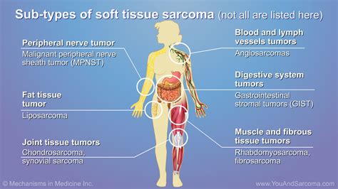 Soft tissue sarcoma 